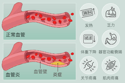 血管炎是一种什么病图片