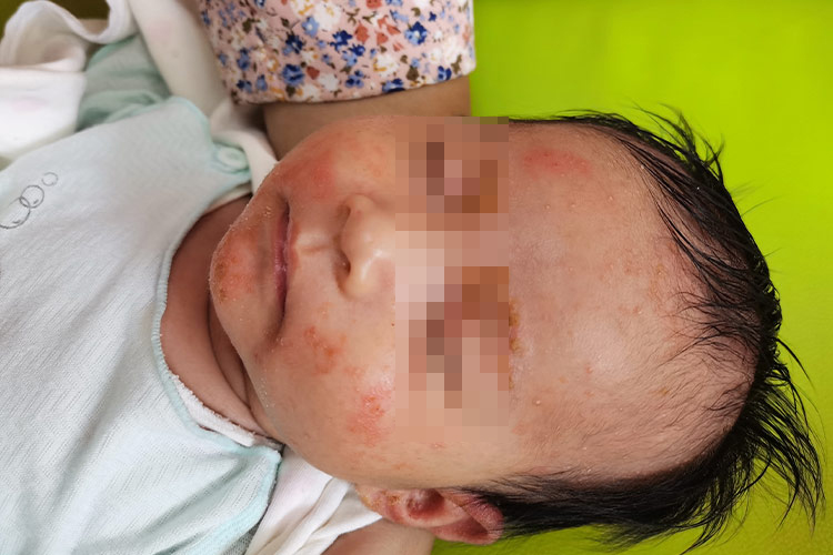 一个月宝宝湿疹和热疹的区别图片