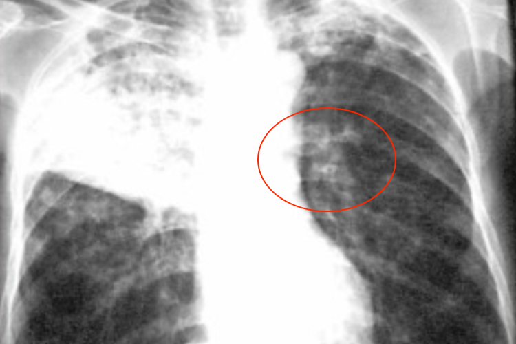 干酪性肺炎X线图