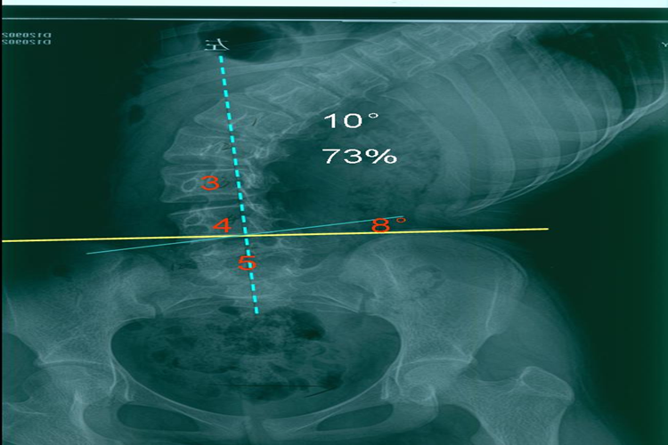 X线下脊柱侧凸图