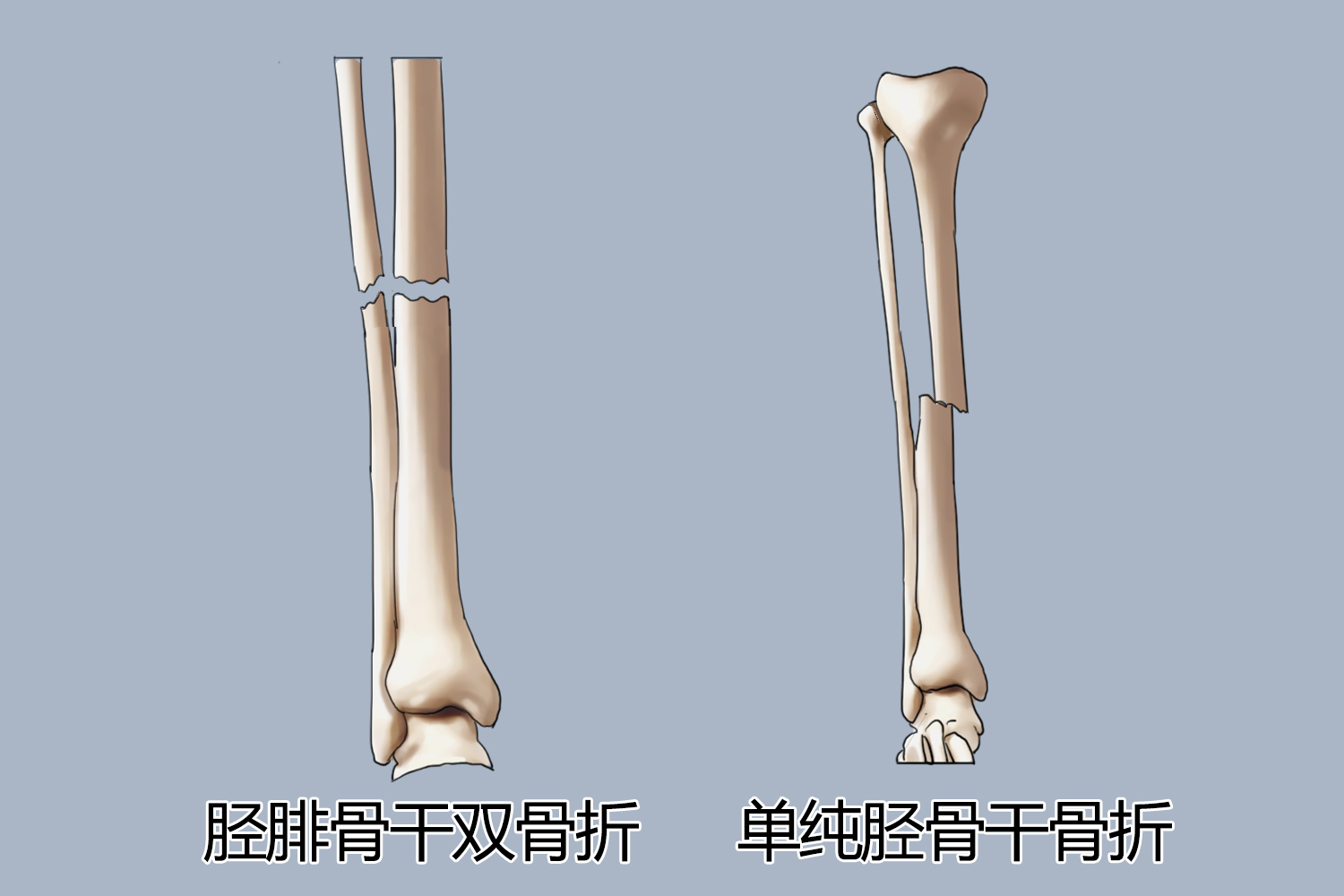 单纯胫骨骨干骨折图