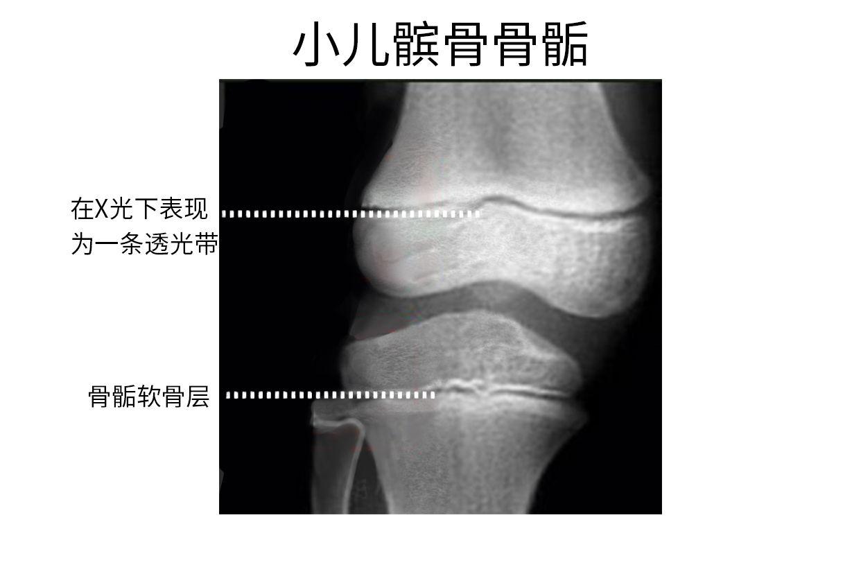 小儿髌骨骨骺X线图