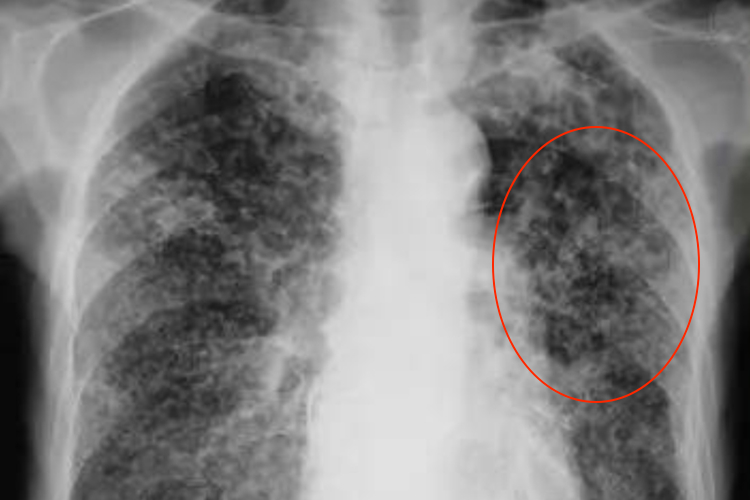 亚急性血行播散型肺结核X线图
