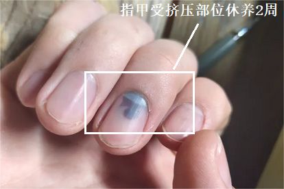 指甲内挤压伤需要几天恢复正常图片