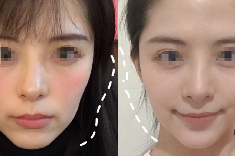脸颊凹陷填充后对比图 | 百度健康·医学科普