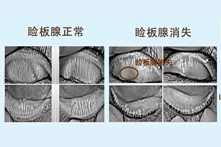 睑板腺缺失图片