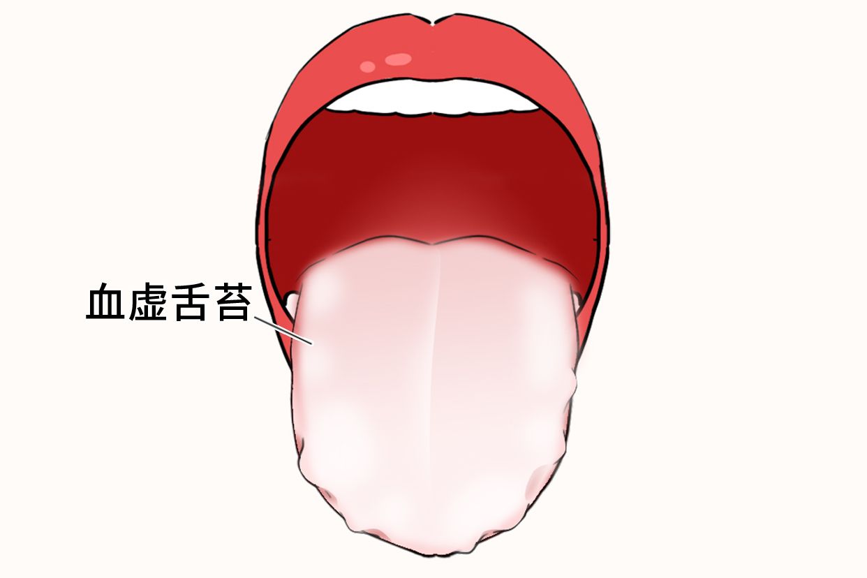 血虚舌苔图片 | 百度健康·医学科普