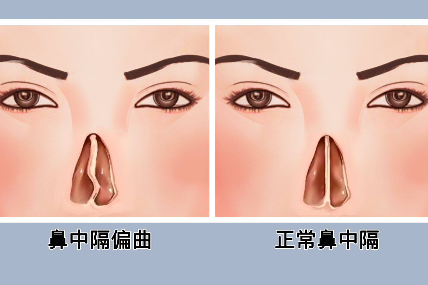 鼻中隔偏曲鼻部图片 | 百度健康·医学科普