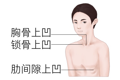 明显三凹征高清图片