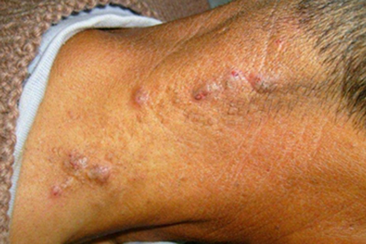 结节性痒疹后颈症状图片