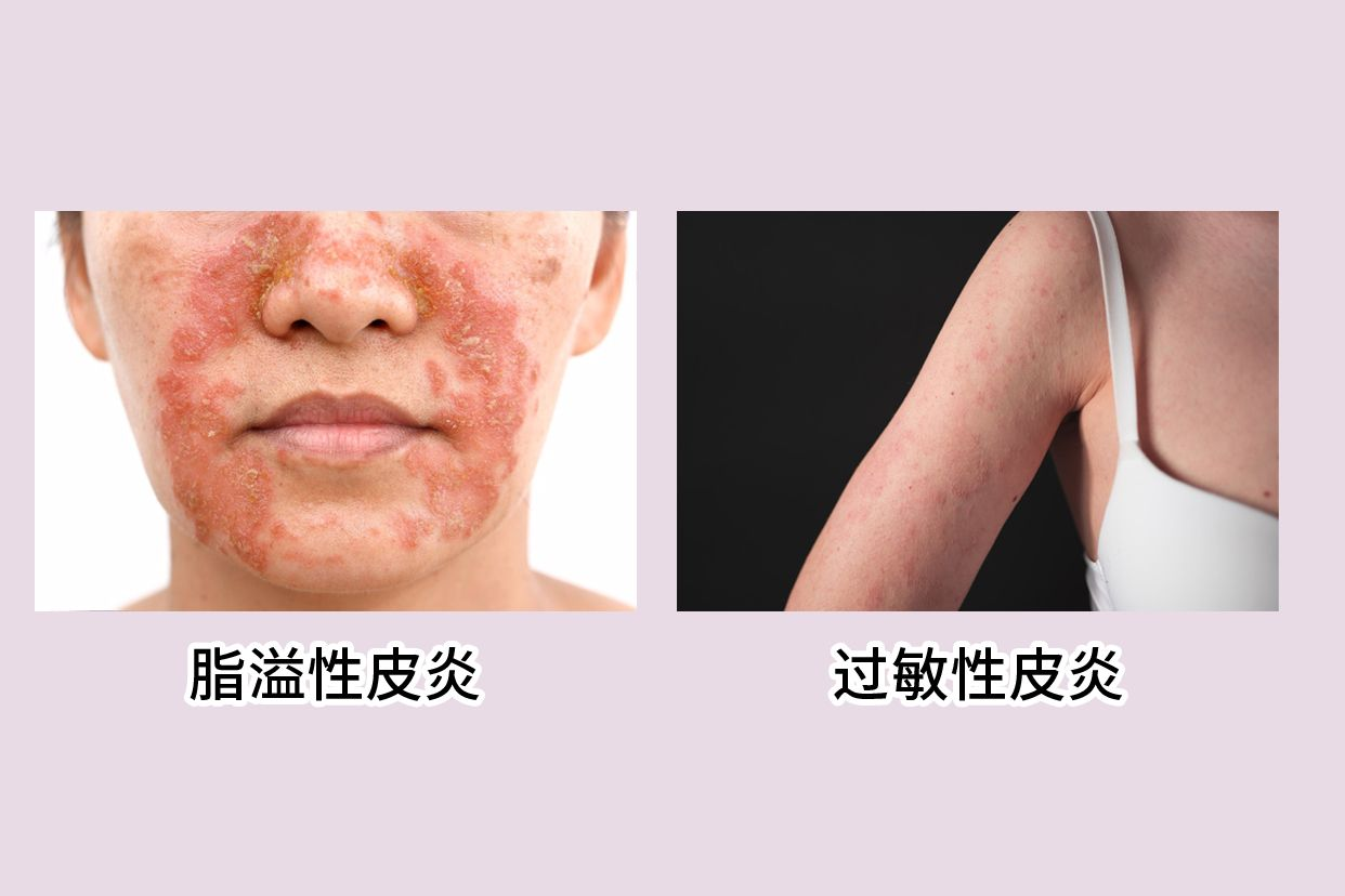 脂溢性皮炎和过敏性皮炎对比图片