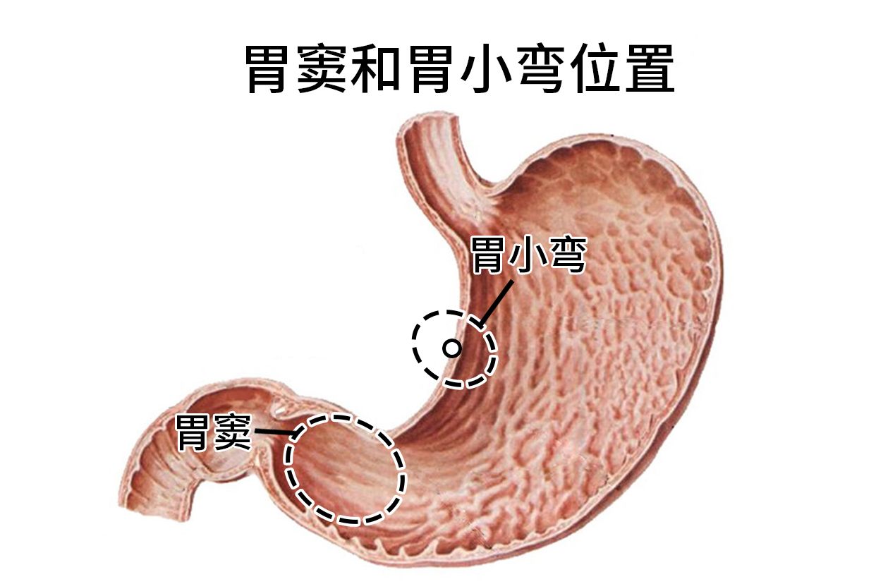 胃窦和胃小弯是一个位置吗
