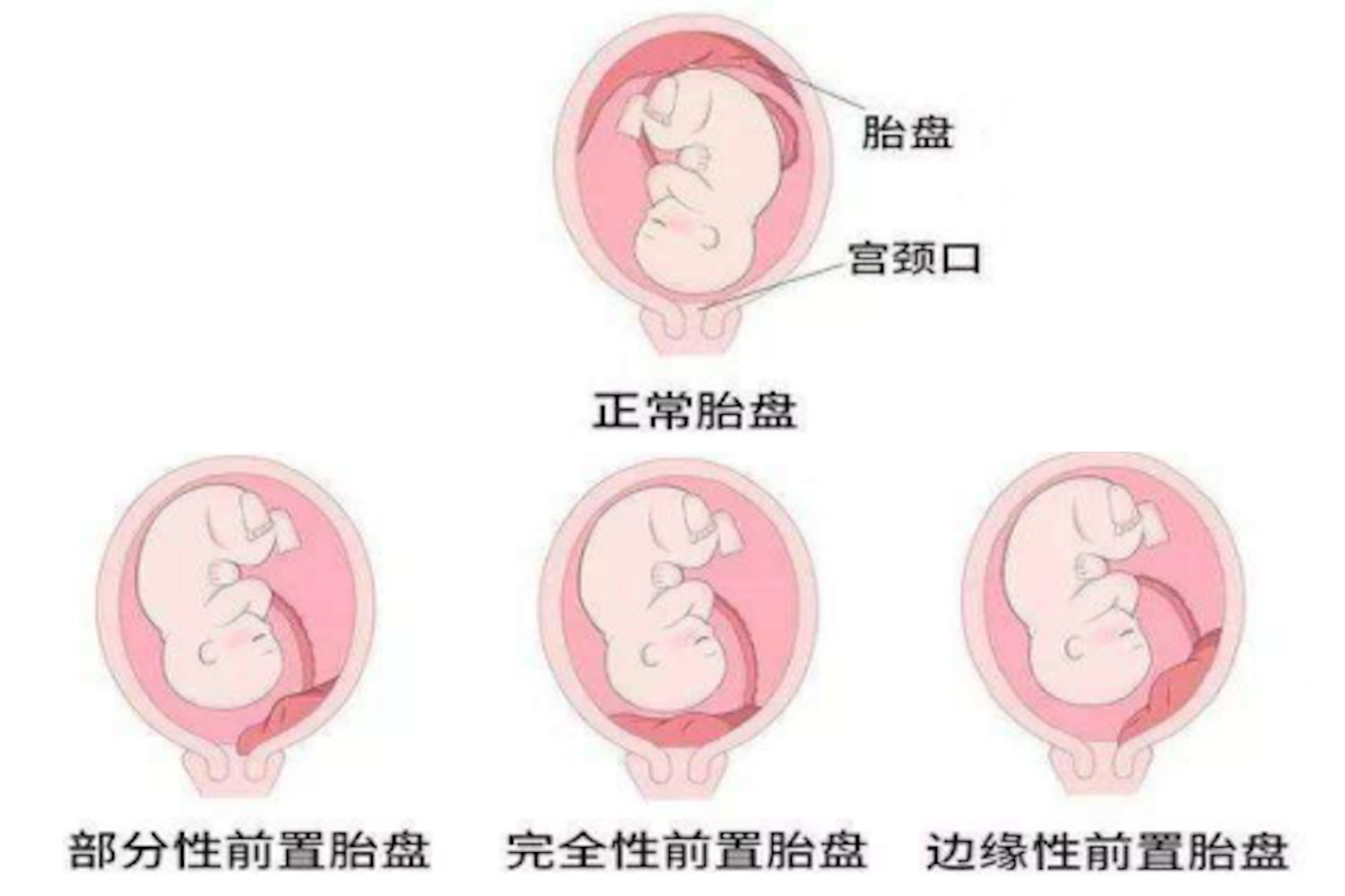 胎盘会不会移动位置