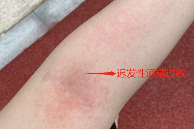 酒精过敏是什么症状图片