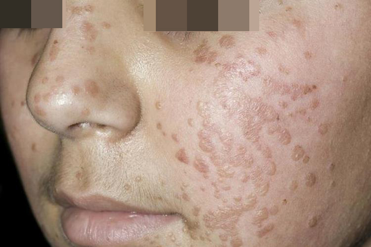 女性HPV脸上长了疣的图片
