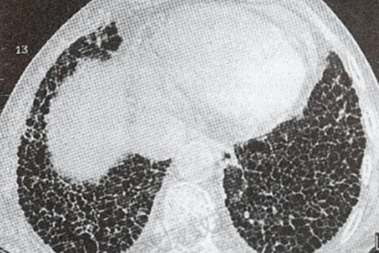 肺间质纤维化引起的肺蜂窝状图