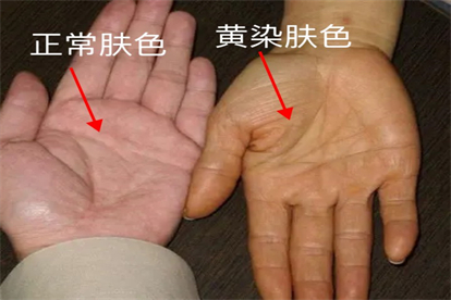 皮肤黄染症状图片 | 百度健康·医学科普