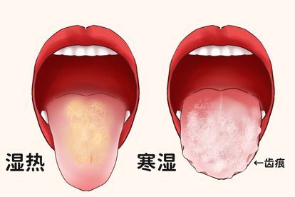 湿热和寒湿的舌苔图片 | 百度健康·医学科普
