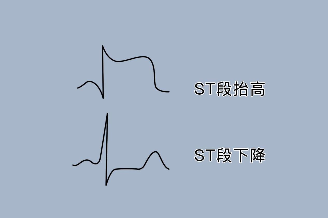 心电图显示st段改变是啥意思? | 百度健康·医学科普