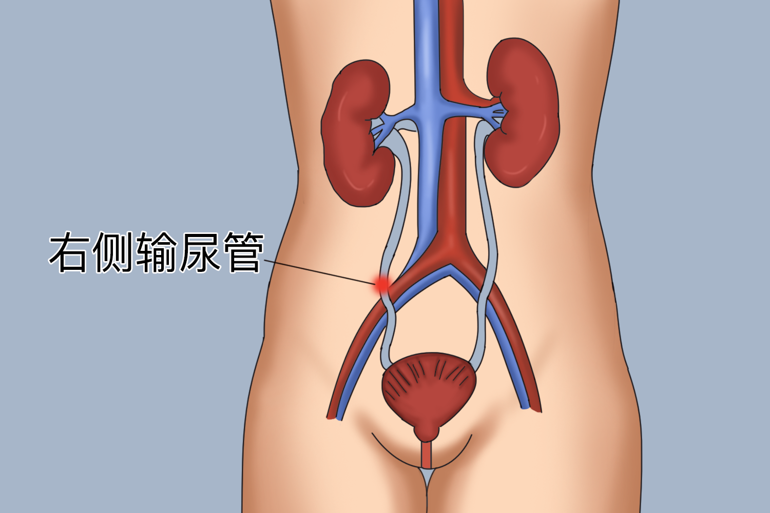 右侧输尿管结石疼痛位置图