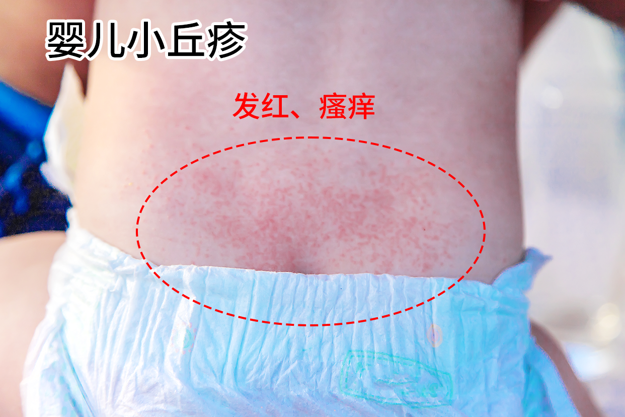 婴儿小丘疹什么样子图片