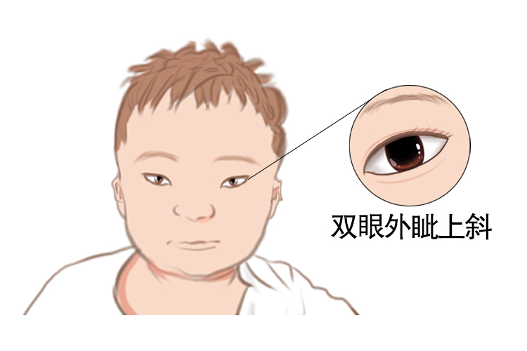 双眼外眦上斜图片 | 百度健康·医学科普