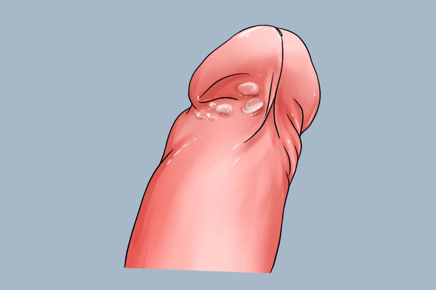 阴茎传染性软疣图