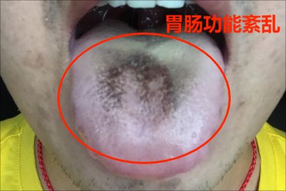 舌头黑是什么病的前兆图片 | 百度健康·医学科普