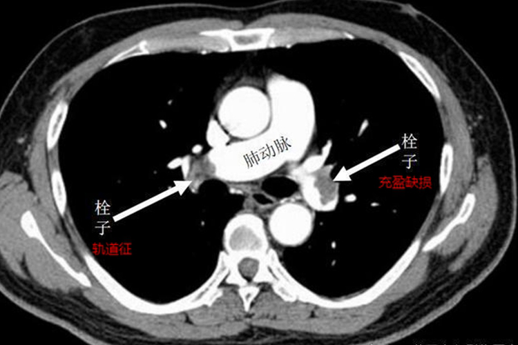 肺栓塞影像图