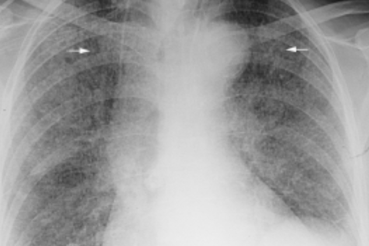 急性血行播散型肺结核X线图