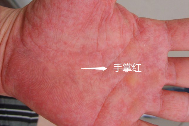 手掌红和肝掌区别图解